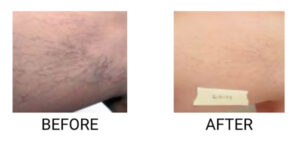 Patient results of before and after spider veins Sclerotherapy treatment